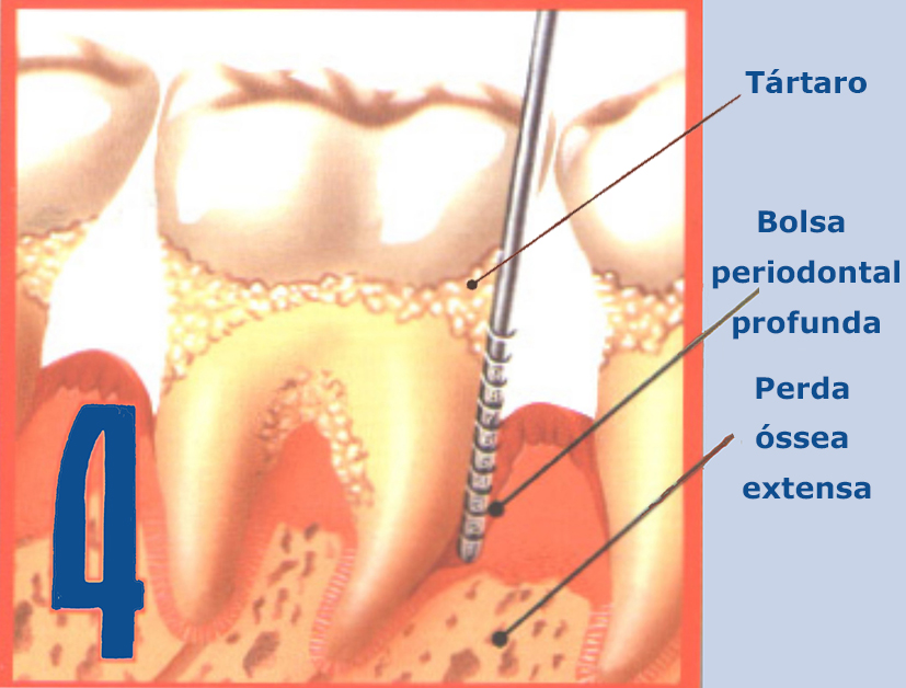 Periodontite avançada