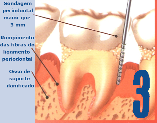 Periodontite inicial